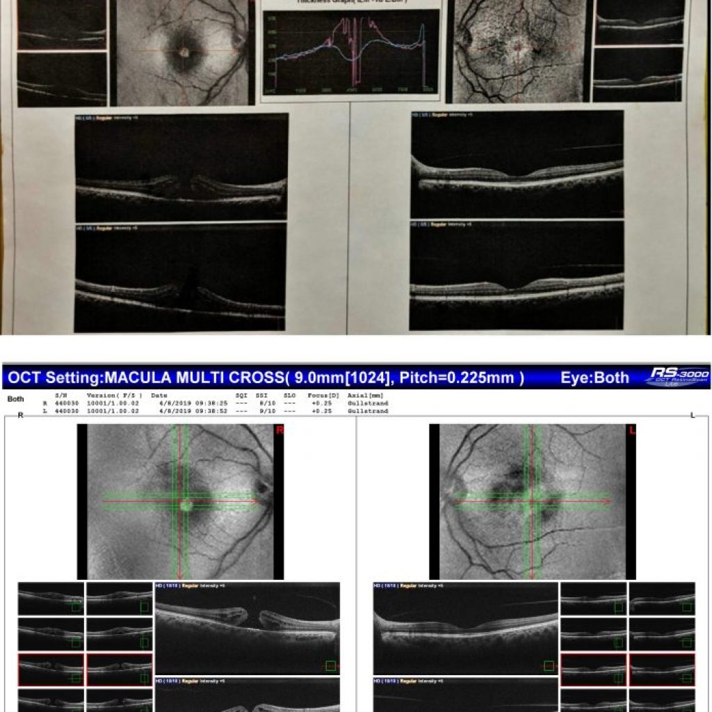 Macular degeneration OCT comparison scan from a second constituent