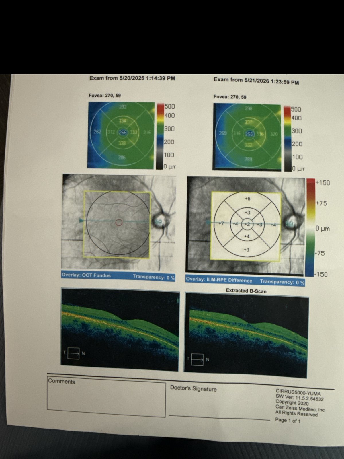 Cirrus OCT macular change analysis report, right eye, comparing two visits one year apart