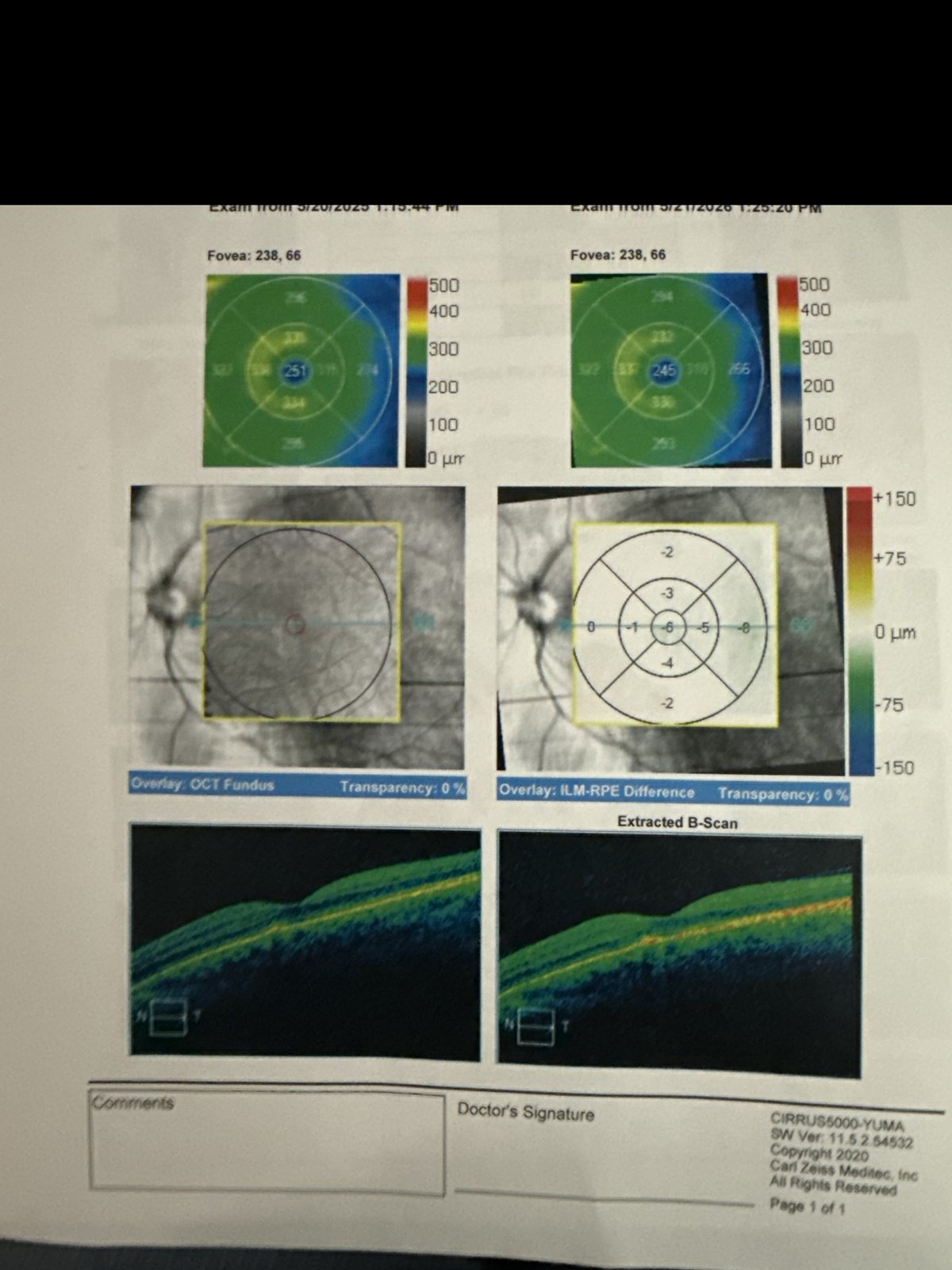 Cirrus OCT macular change analysis report, left eye, comparing two visits one year apart